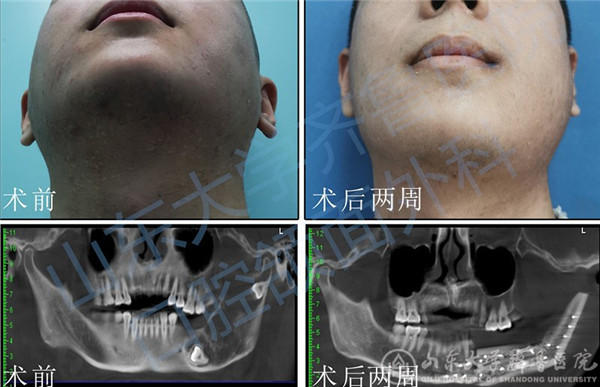 口腔颌面外科完成经口内显微血管吻合腓骨肌皮瓣重建下颌骨手术